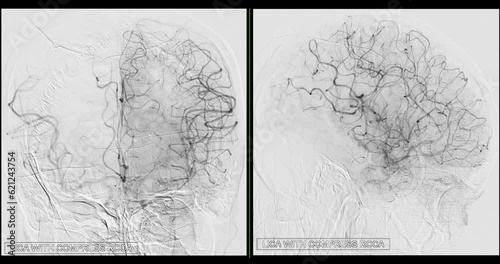 Cerebral angiogram ofCerebral artery for diagnosis  cerebral artery aneurysms and cerebral artery disease such as atherosclerosis (plaque). photo