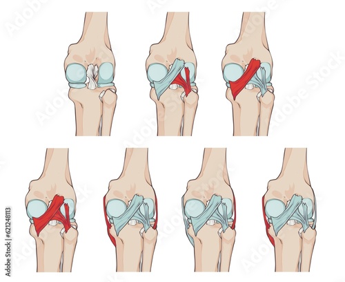 knee ligaments and menisci, with oblique popliteal ligament, medial fascicle of arcuate popliteal ligament, lateral fascicle of arcuate popliteal ligament and tibial collateral ligament 