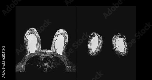 Breast MRI magnetic resonance imaging of the breast in case Breast implants for screening for breast cancer. photo