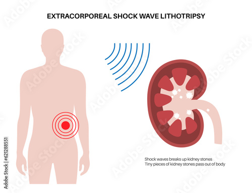 Lithotripsy procedure concept