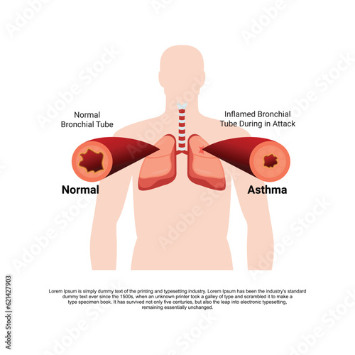 An asthma-inflamed bronchial tube