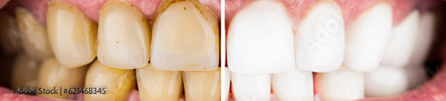 Man before and after teeth whitening procedure, closeup. Male teeth before and after whitening, oral care dentistry, stomatology