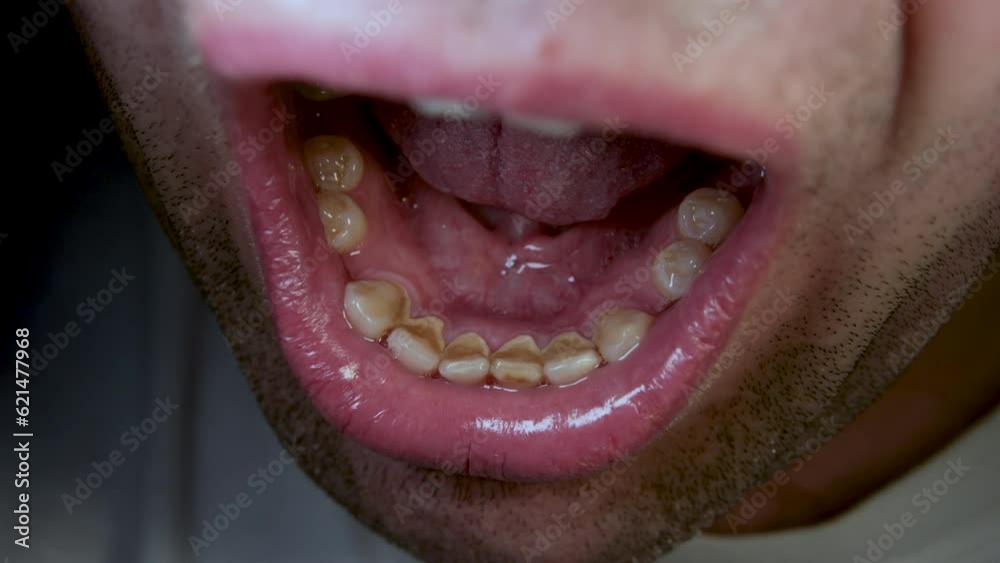 Close up of male wide open mouth while exposing his yellowish back of teeth and some missing and rotten teeth.