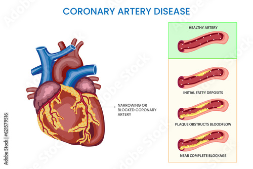 Coronary artery disease,  Narrowed arteries, reduced blood flow, increased risk of heart complications