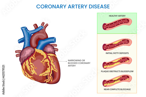 Coronary artery disease is a condition where the coronary arteries narrowed or blocked, reducing blood flow to the heart and increasing the risk of heart attacks and other cardiovascular complications photo