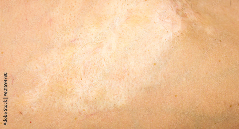 Burn scars, burn scars on the body. Consequences of burns. Burn scars, burn scars on the body. Consequences of burns.