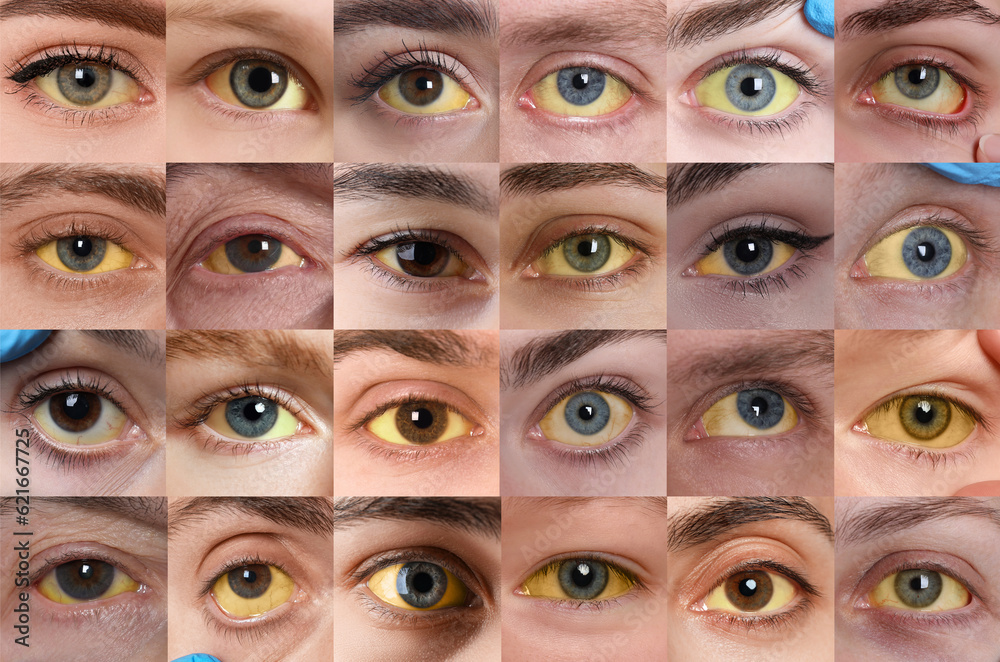 Yellowing of eyes as symptom of hepatitis. Collage with photos of