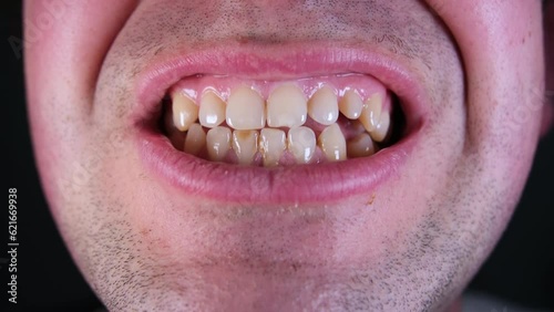 Close up of slightly yellowish adult male teeth while grinding top and bottom jaw with some missing teeth and or spaces in back. 