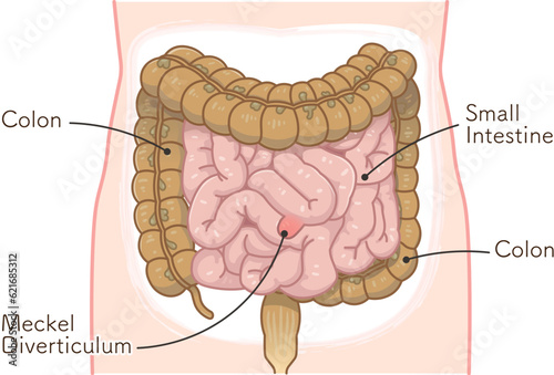 Diverticulum・ meckel diverticulum・small intestine・colon・illustration