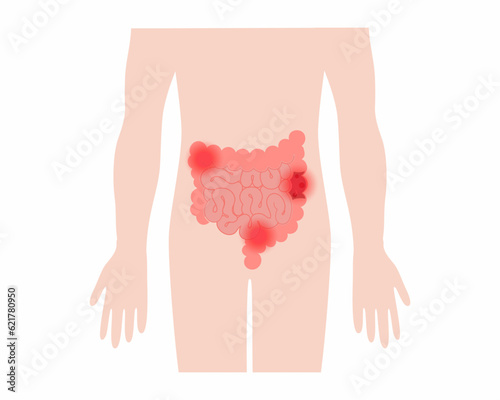 Inflammatory bowel disease abdominal pain in colon Human large intestines anatomy