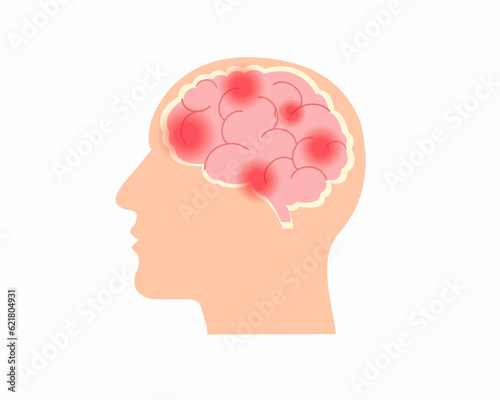 Hemorrhagic human brain stroke problem bleeding in human head medical and health care concept.