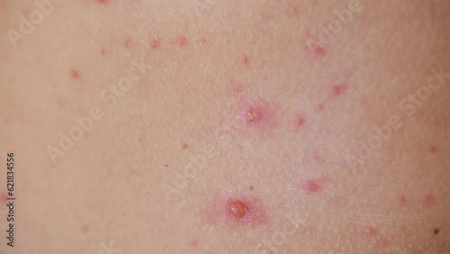 The classic symptom of chickenpox is a rash that turns into itchy, fluid-filled blisters.