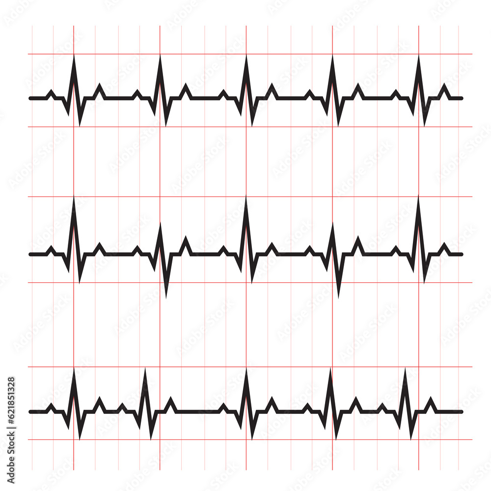 Normal and abnormal ECG cardiogram diagram schematic raster illustration. Medical science educational illustration