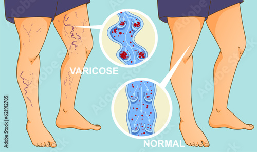 Human body with health problems. Varicose veins. Vein Comparison. Before, after. Vector illustration. Healthcare illustration. 