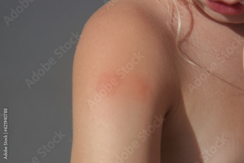 Little girl has skin rash from allergy or mosquito bites 