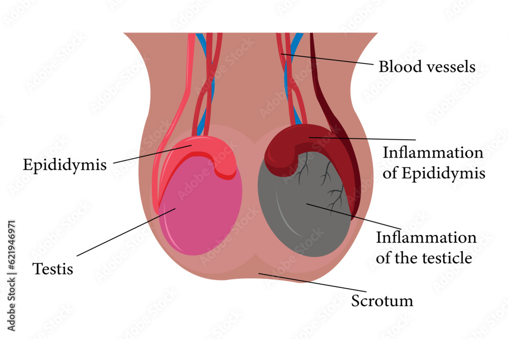 illustration of epididimitis (inflamasi epididimis). Epididymitis is