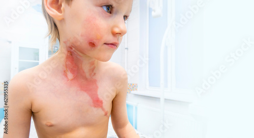 dressing a boy with a burn from boiling water