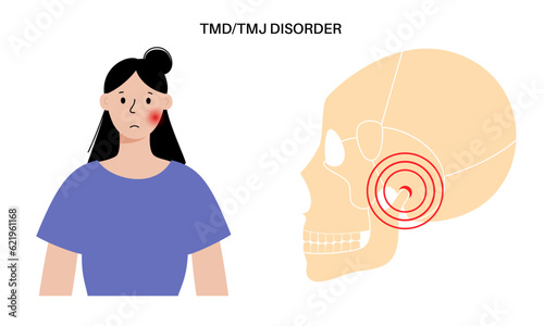 TMD TMJ disorder photo