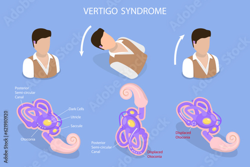 3D Isometric Flat Vector Conceptual Illustration of Vertigo Syndrome , BPPV photo