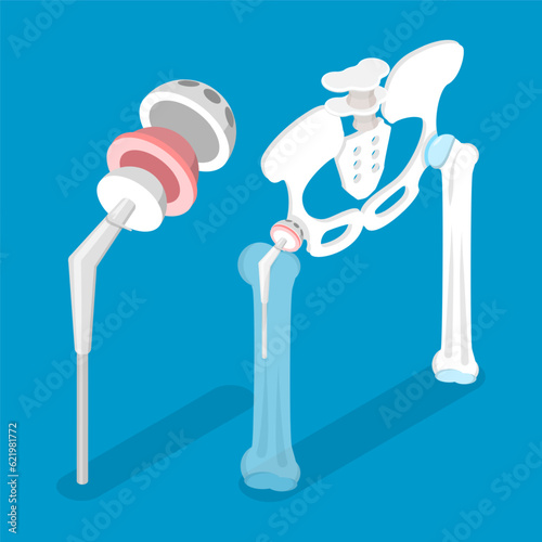 3D Isometric Flat Vector Conceptual Illustration of Total Hip Replacement, Joint Implant