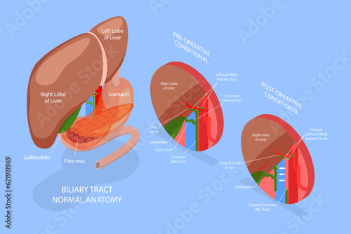 3D Isometric Flat Vector Conceptual Illustration of Gallbladder Removal Surgery, Cholecystectomy