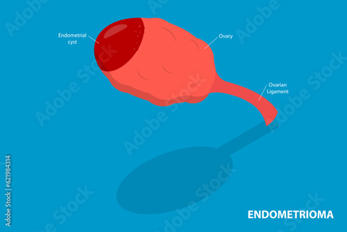 3D Isometric Flat Vector Conceptual Illustration of Endometrioma, Ovarian Cyst
