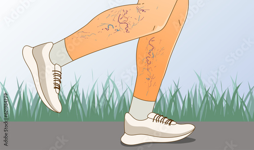 Human legs with health problems. Varicose veins. Vector illustration. Healthcare illustration. 