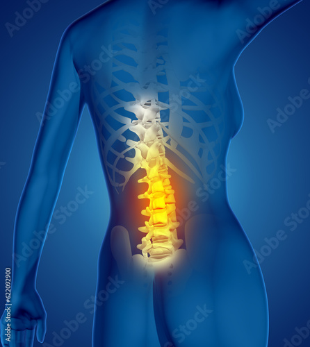 3D render of a female medical figure with spine highlighted