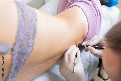 the doctor removes the mole for histological examination. Dermatologist removes a mole