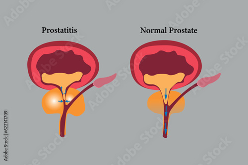 comparation of health prostate and unhealth prostate. prostatitis illustration icon set. eps 10 photo