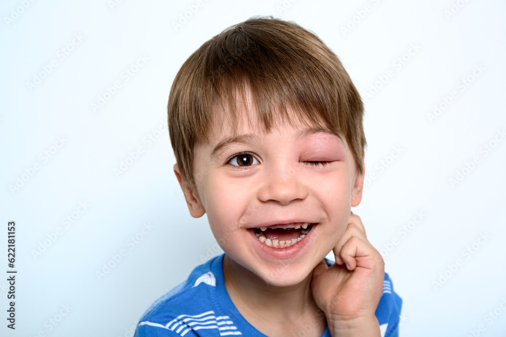 Child with swollen eye from insect bite. Face of allergic person