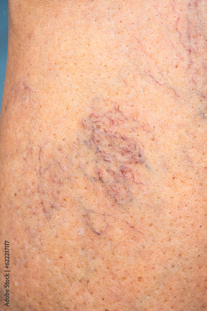 Fototapeta premium Varicose veins on female leg