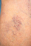 Varicose veins on female leg