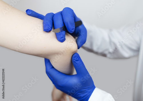 Elbow surgery. Surgeon shows the patient where the incision will be with scalpel for operation due to tendon rupture, cartilage damage, bone prick. Concept of restoring joint mobility and arthroplasty