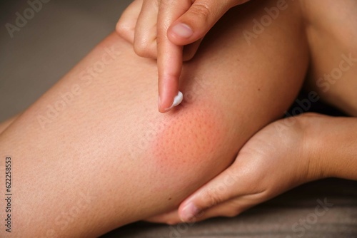 Woman applying medicine cream on mosquito bite on her leg. Allergic reaction, itch, irritation due to insect bite concepts.