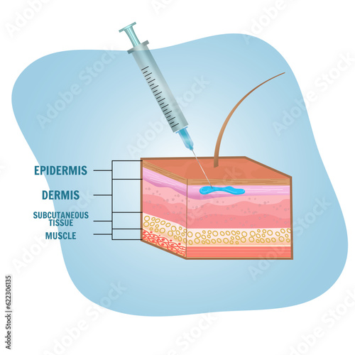 Layers of skin with injection in vector illustration 