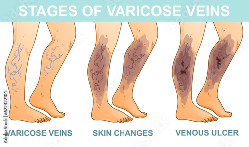 Human legs with health problems. Varicose veins. Stages of vein disease. Medical infographic. Vector illustration. Healthcare illustration. 