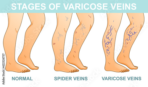 Human legs with health problems. Varicose veins. Stages of vein disease. Medical infographic. Vector illustration. Healthcare illustration.  photo