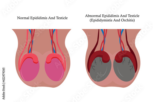 illustration comparation of normal epididimis and testis, and abnormal epididimis and testis (epididimitis orchitis). eps 10