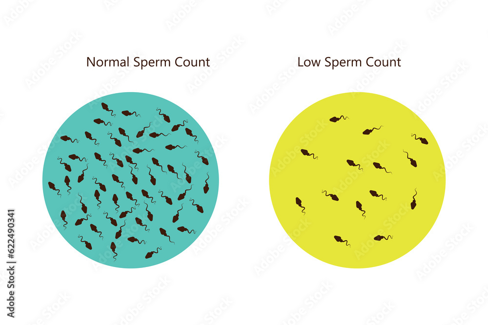 Sperm Count Collection Process normal and low sperm count illustration. Male infertility oligospermia ...