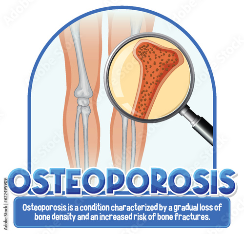 Informative poster of Osteoporosis human bone