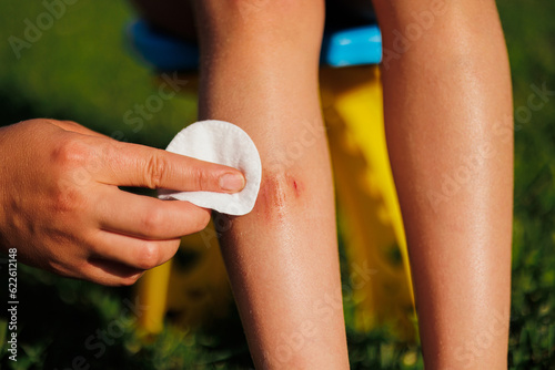 A woman's hand heals a child's wound below the knee. A child sits on a chair and green grass in the summer. Treatment of the wound. First aid. Close-up photo.