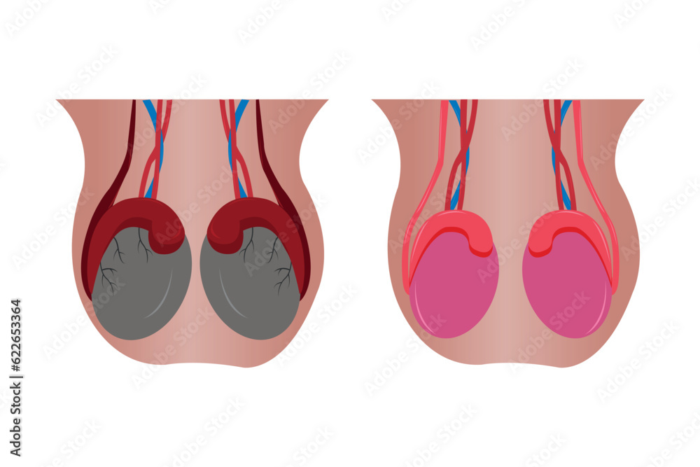 Illustration Comparation Of Normal Epididimis And Testis And Abnormal Epididimis And Testis 