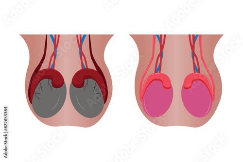 illustration comparation of normal epididimis and testis, and abnormal epididimis and testis (epididimitis orchitis). eps 10