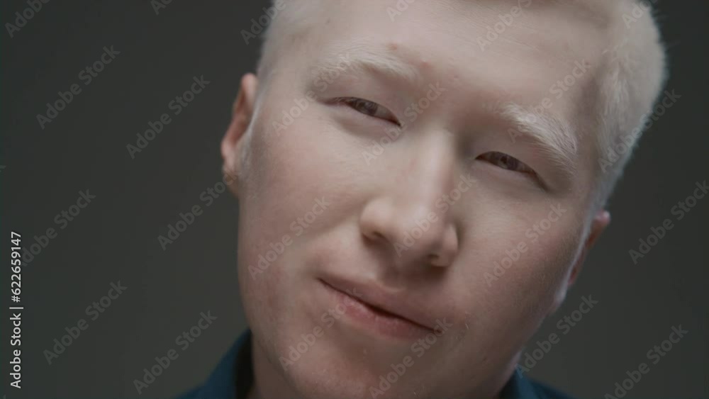 Close up portrait of an albino Asian guy looking at the camera. Genetic ...
