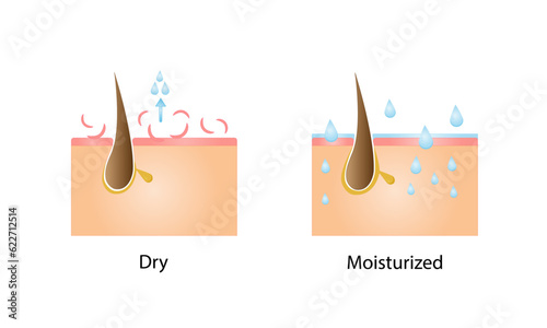 Dry and moisturized  skin. Skin cross section. Moisturized pore and dry pore. Vector illustration.