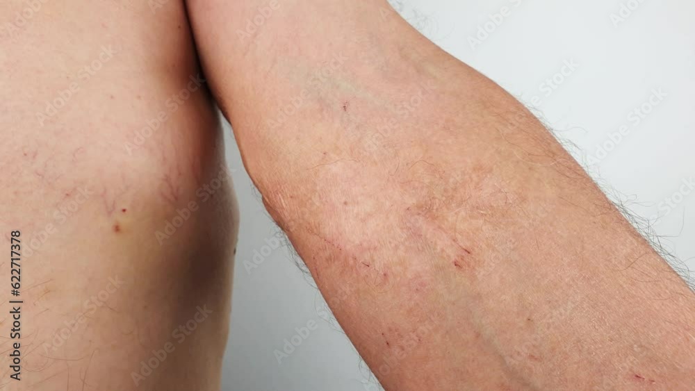 Burn scars, burn scars on the arm. Burn scars, burn scars on the arm.