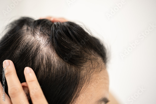 Asian woman parting her hair revealing hair loss or thinning hair.