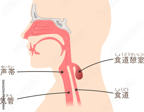 食道憩室・ゼンカー憩室・zenker憩室・憩室穿孔・憩室のイラスト