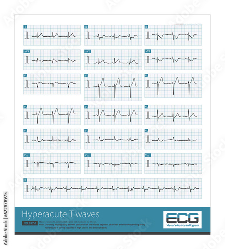 Quadro em tela Male, 65 years old, admitted to hospital with chest pain for 2 hours